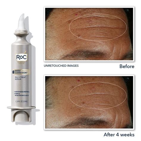 roc fill and treat serum before and after|roc retinol serum reviews.